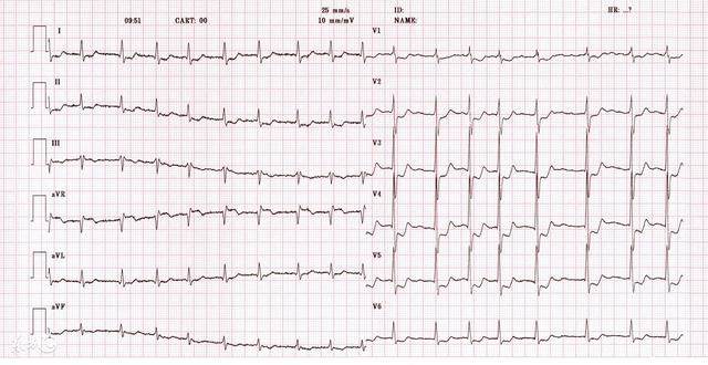 早搏人口_室性早搏心电图
