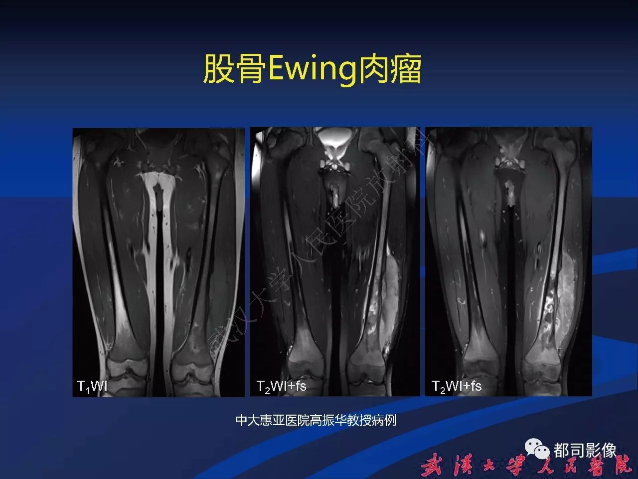 ewing 肉瘤家族肿瘤影像诊断