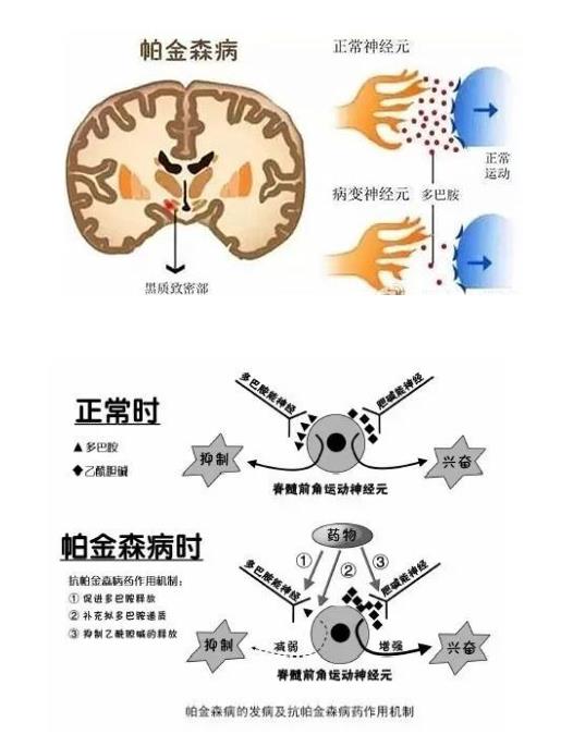 帕金森病是由于大脑黑质多巴胺(dopamine da)能神经元的变性死亡