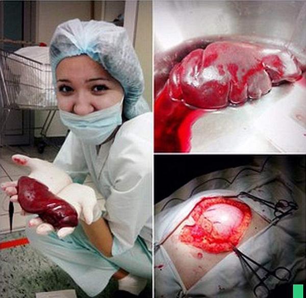 护士晒出手捧病人被移除的脾脏的照片