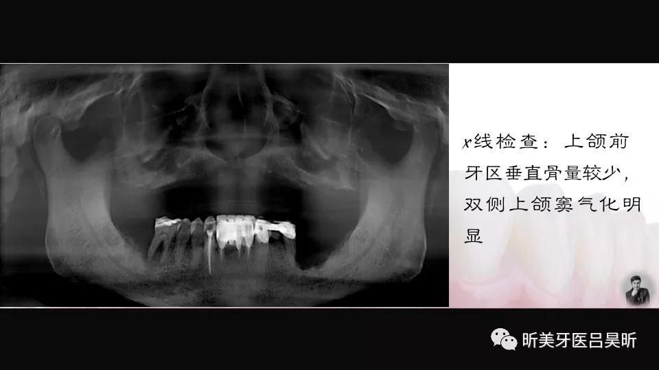 allon4联合上颌结节种植一例