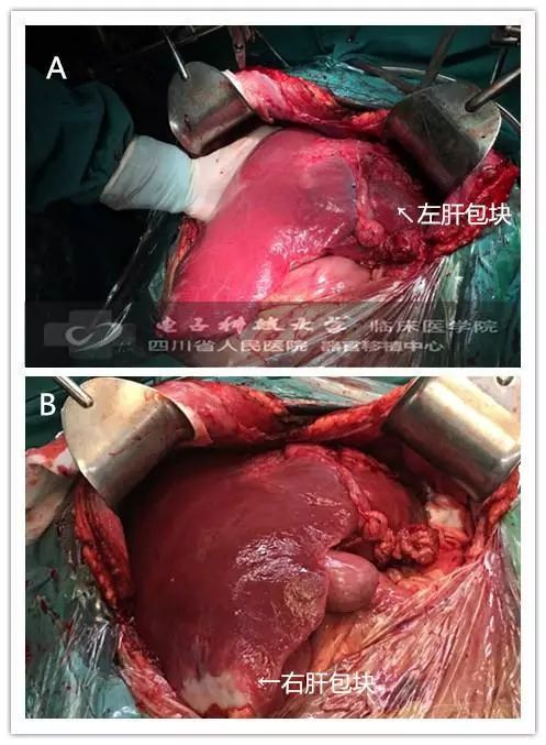 切开腹壁,显露病变手术步骤(图文解析)图 3 腔静脉造影图像腔静脉