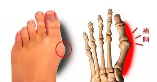 是指脚大拇趾在第一跖趾关节处向外侧偏斜,关节内侧出现明显的骨赘,有