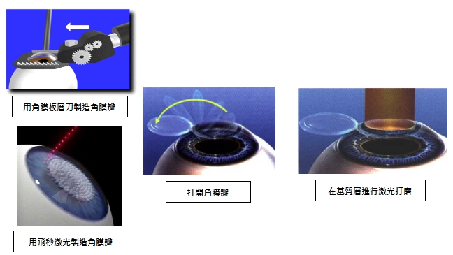 近视矫正手术的原理_从原理讲透彻 东莞全飞秒近视手术的利与弊(3)