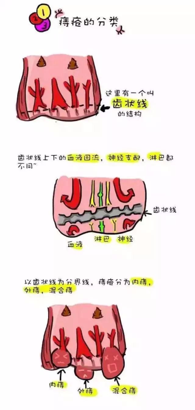 【涨姿势】痔疮是个什么鬼?