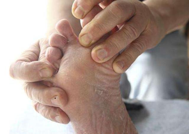 预防脚部的磨伤,每天检查脚疮,水泡,红肿,老茧或上述任何其他问题.