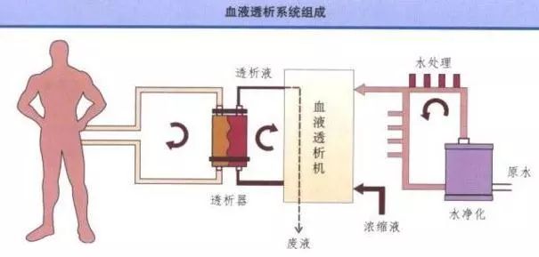 血液透析通过什么原理排水_血液透析原理示意图