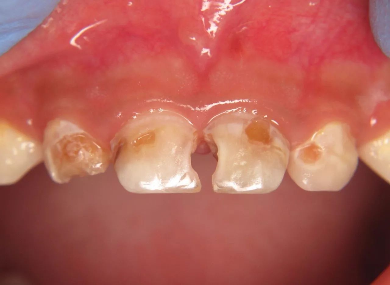 [儿童科普] 关注牙齿发育健康,注意龋齿的发生