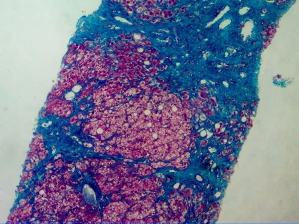 为进一步明确是否酒精肝损伤,有无其他损伤原因,进行了肝穿刺组织学