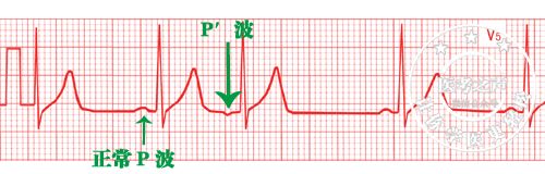 所以前提是 具备窦性心律的特点 只是窦房结心情压抑不想动 窦房结