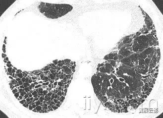 特发性肺纤维化特指一类病因不明的慢性纤维化性间质性肺炎,组织学