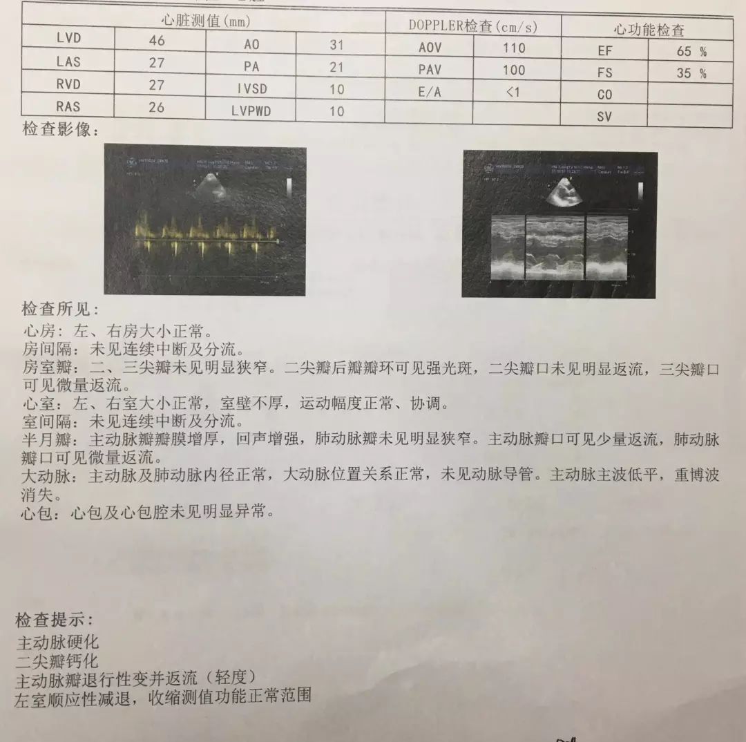 段娟acs合并消化道出血高风险病例1例