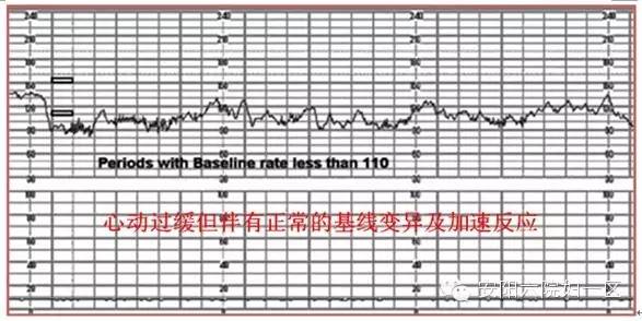 监测胎儿宫内健康胎心监护解读56