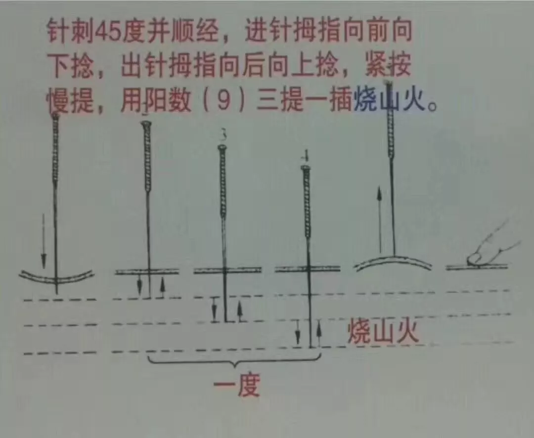 各种刺法没有文字只有图看图学针灸