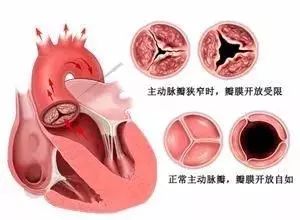 心外科华正东主任 心脏主动脉瓣膜病——一般指的是主动脉瓣狭窄,主