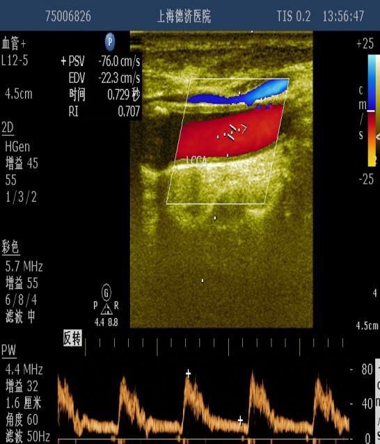 (图二:为颈总动脉频谱流速测量)