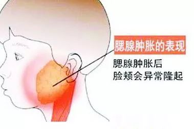 腮腺炎脖子变粗怎么办