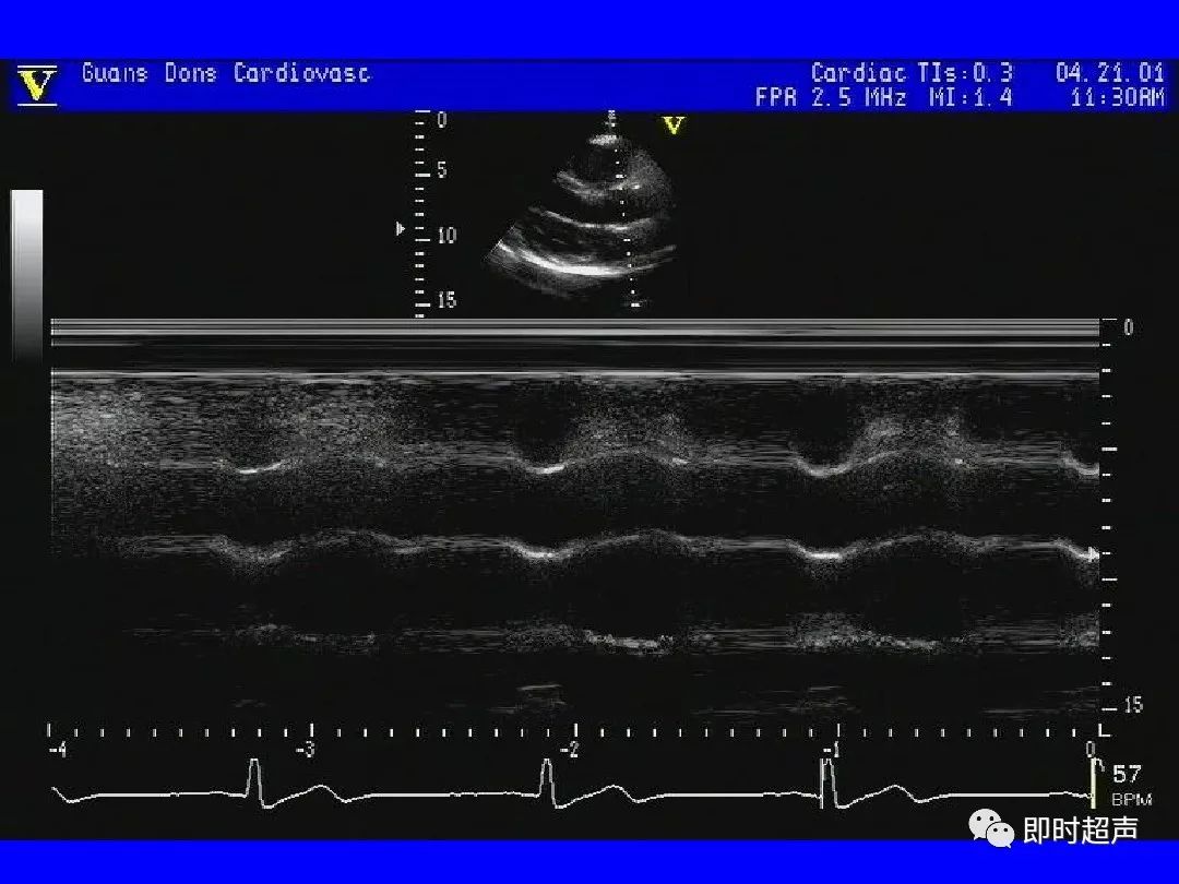 心脏超声标准切面及测量