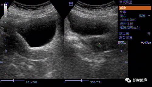 膀胱癌的超声影像诊断分析