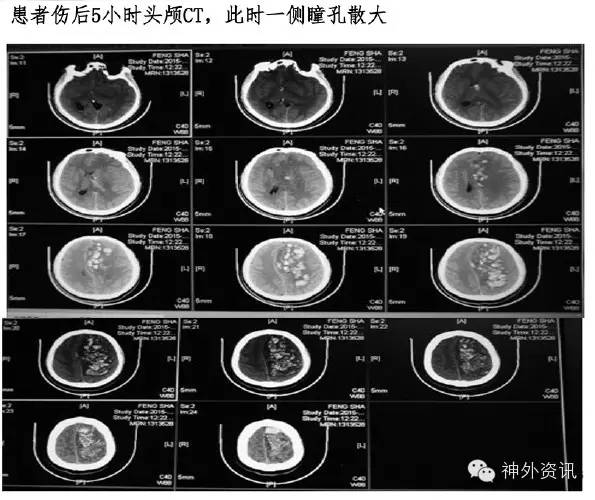 成功救治危重颅脑损伤患者一例丨颅脑创伤-神经重症病例周刊(第48期)