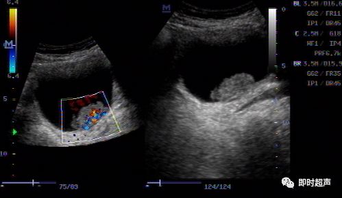 膀胱癌的超声影像诊断分析