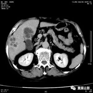 【病例】胆囊癌的影像学表现