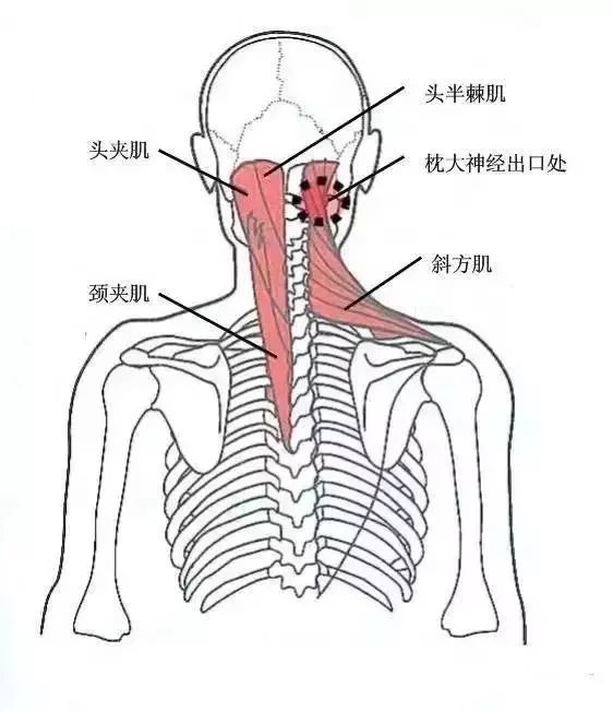 该处为头半棘肌,枕大神经的出口处,枕骨粗隆下(近风池穴),颈项酸痛者