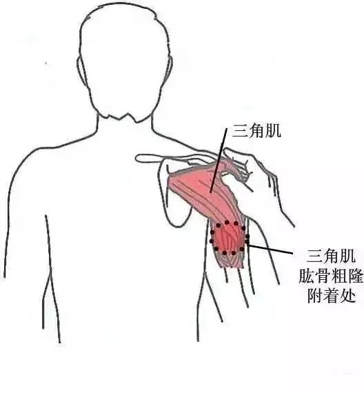 压痛干货康复治疗师必知软组织常见压痛点