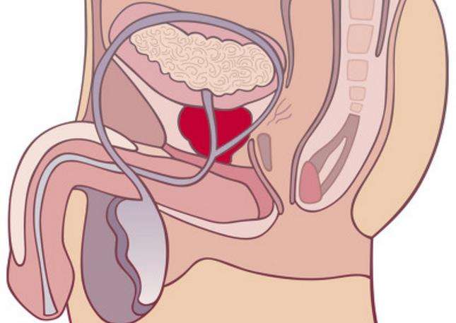 医生表示频繁性冲动导致前列腺反复充血,引发炎症不说,还大大增加了