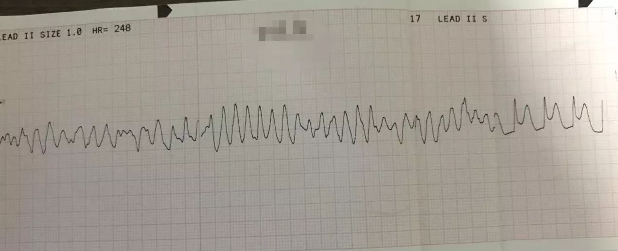 qrs-t波群消失,提示患者出现心室颤动,需马上电除颤!