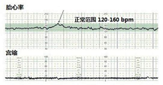 生命银行教你如何看懂胎心监护图!