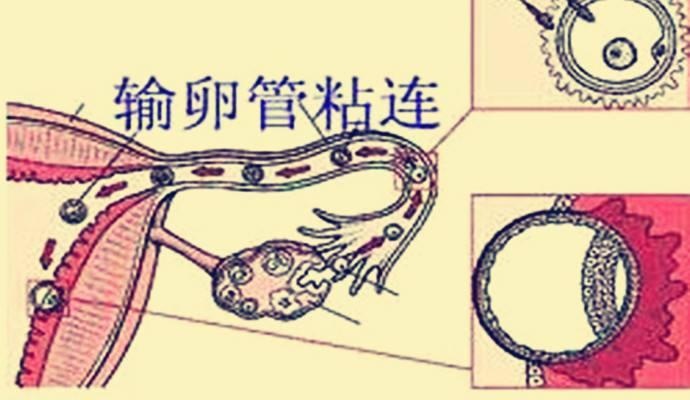 输卵管堵了,还能怀孕吗?