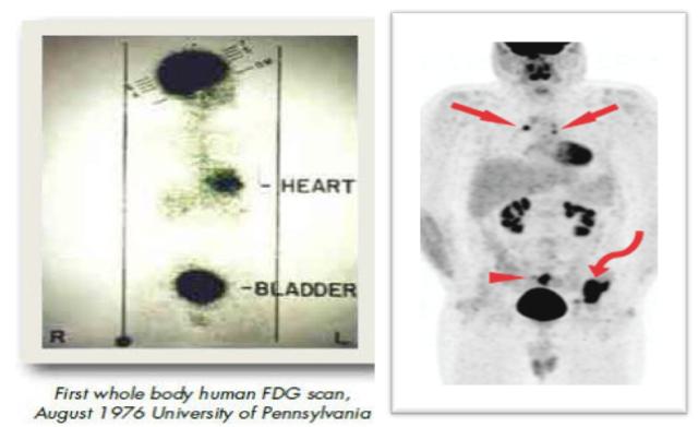 鱼与熊掌 可以兼得——肿瘤筛查神器pet/ct