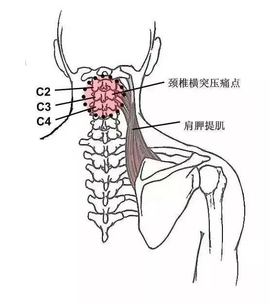 也常可见到上述颈椎横突出现压痛