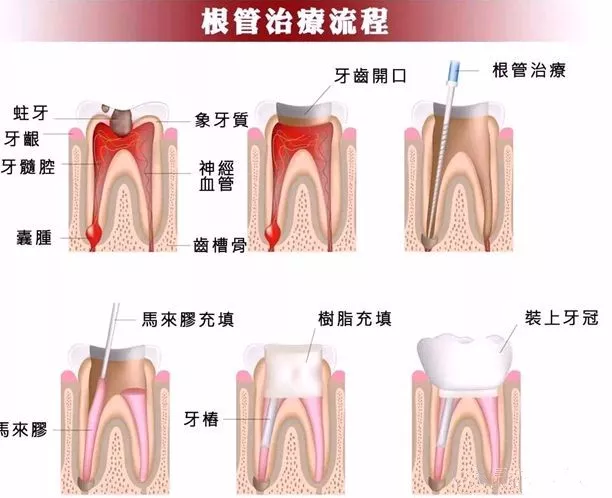 牙髓外露:当牙齿意