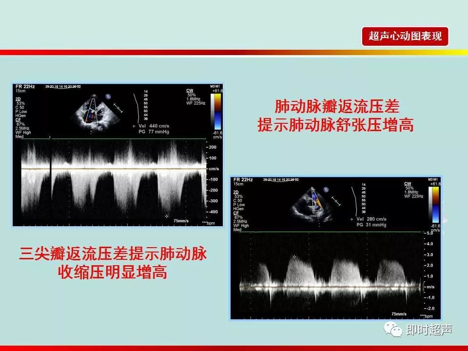 房间隔缺损的超声诊断