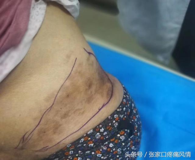 健康 正文 患者,女,65岁,患带状疱疹后遗三月左右,俗称"缠腰龙,蛇盘腰