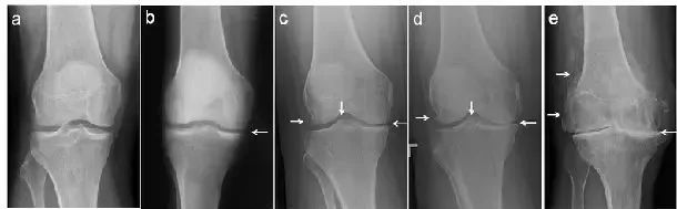 膝关节的各种x线拍票眄现