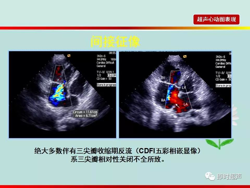 房间隔缺损的超声诊断