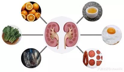 泌尿系结石的10大误区