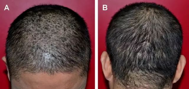 弥漫性脱发表现为广泛脱发,这可能为反应性的静止期脱发,而非螺旋体