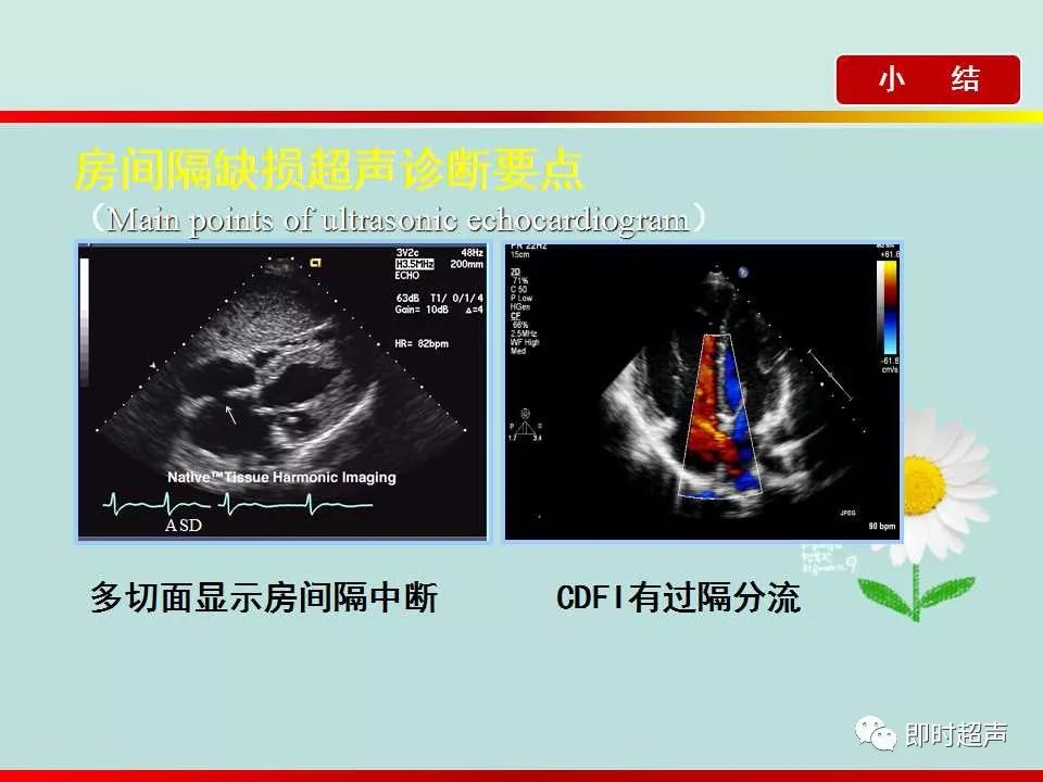 房间隔缺损的超声诊断