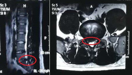 患者腰椎核磁共振图像显示:腰5/骶1右侧椎间盘突出 神经根受压