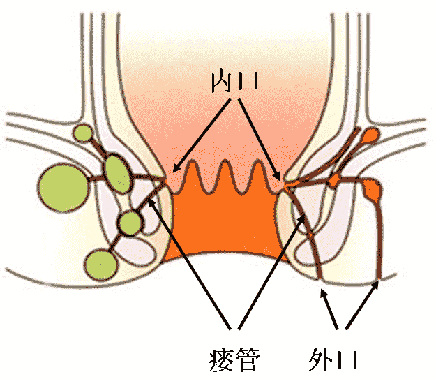 肛周脓肿代表急性炎症期,而肛瘘则代表慢性进程.