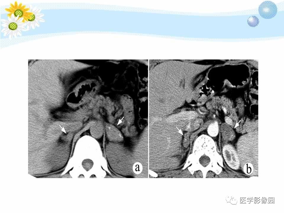 肾上腺肿瘤性病变的ct诊断丨影像天地