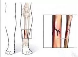 对于胫骨骨膜炎来说,疼痛一般集中于小腿前方,运动导致应力集中,疼痛