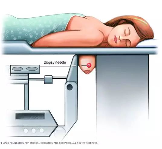 细针穿刺(fine-needle aspiration)