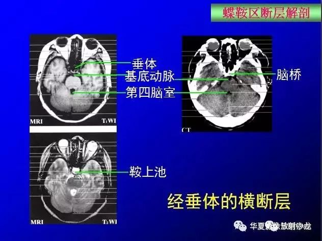 这么全的鞍区影像解剖,赶紧收藏备用!