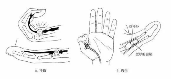 推荐| 狭窄性腱鞘炎的治疗策略