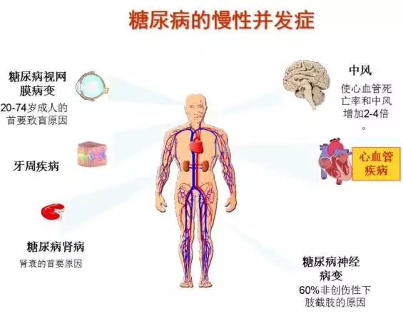 糖尿病并发症 糖尿病不可怕,可怕的是并发症.就目前的医疗水平来说